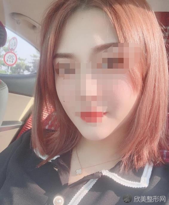 丁合军医生做吸脂瘦脸之后
