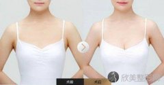 自体脂肪隆胸怎么护理呢?自体脂肪隆胸的风险与预防应该怎么做?