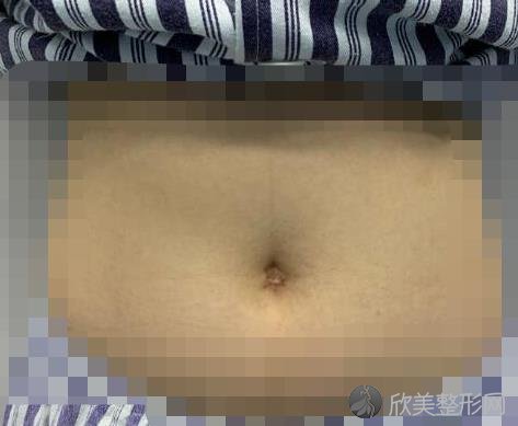 张效恩院长抽脂瘦腰之前