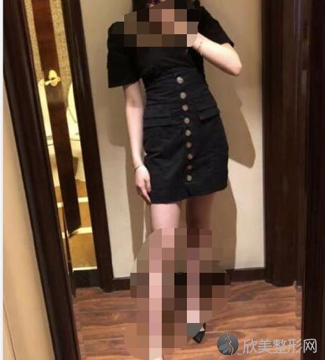 张效恩院长抽脂瘦腰之后