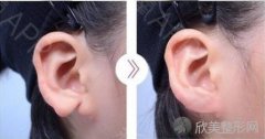 耳部整形的类型以及术中术后应注意的事项!