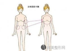 自体脂肪丰胸手术费大概要多少钱？有哪些因素