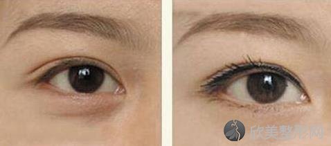 无痕去眼袋效果怎么样无痕去眼袋保持几年？有哪些优点和副作用