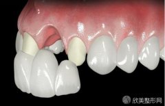 牙齿修复的几种方法?牙及术前的注意事项
