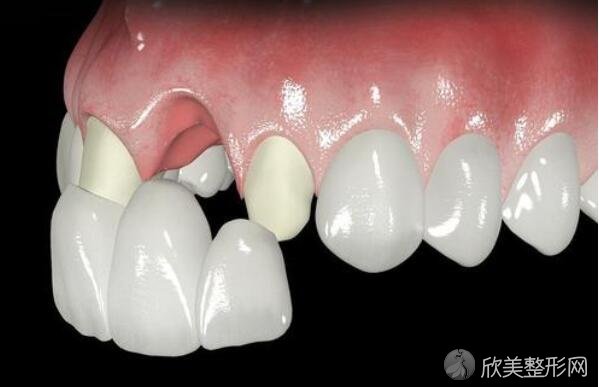 牙齿修复的几种方法?牙及术前的注意事项