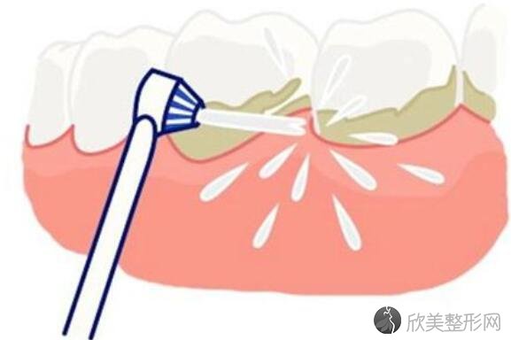 洁牙洗牙对牙齿有害吗?会损伤牙齿么