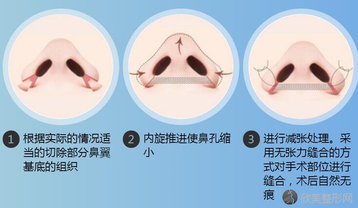鼻头鼻翼缩小方法有哪些？鼻头鼻翼缩小整形手术过程