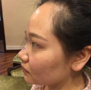 玻尿酸隆鼻前后的对比照，附隆鼻子真实案例！