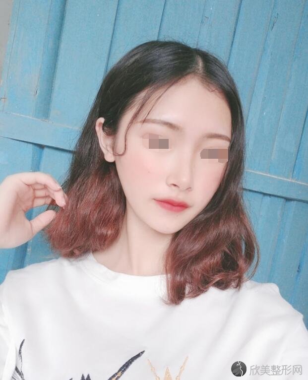 吸脂瘦脸术后20天