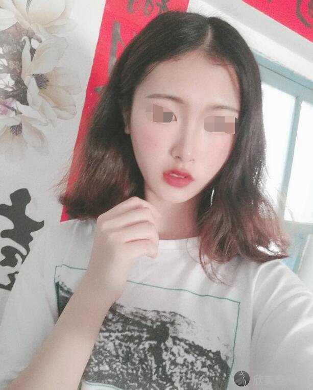 吸脂瘦脸术后30天