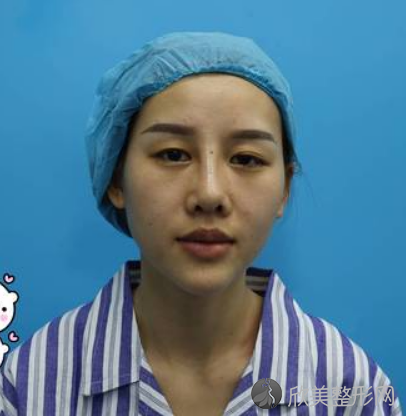 北京惠美整形医院做耳软骨鼻案例
