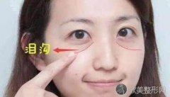 自体脂肪填充泪沟后的注意事项-预防措施大分享