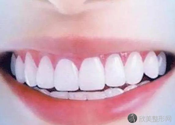 牙齿美白