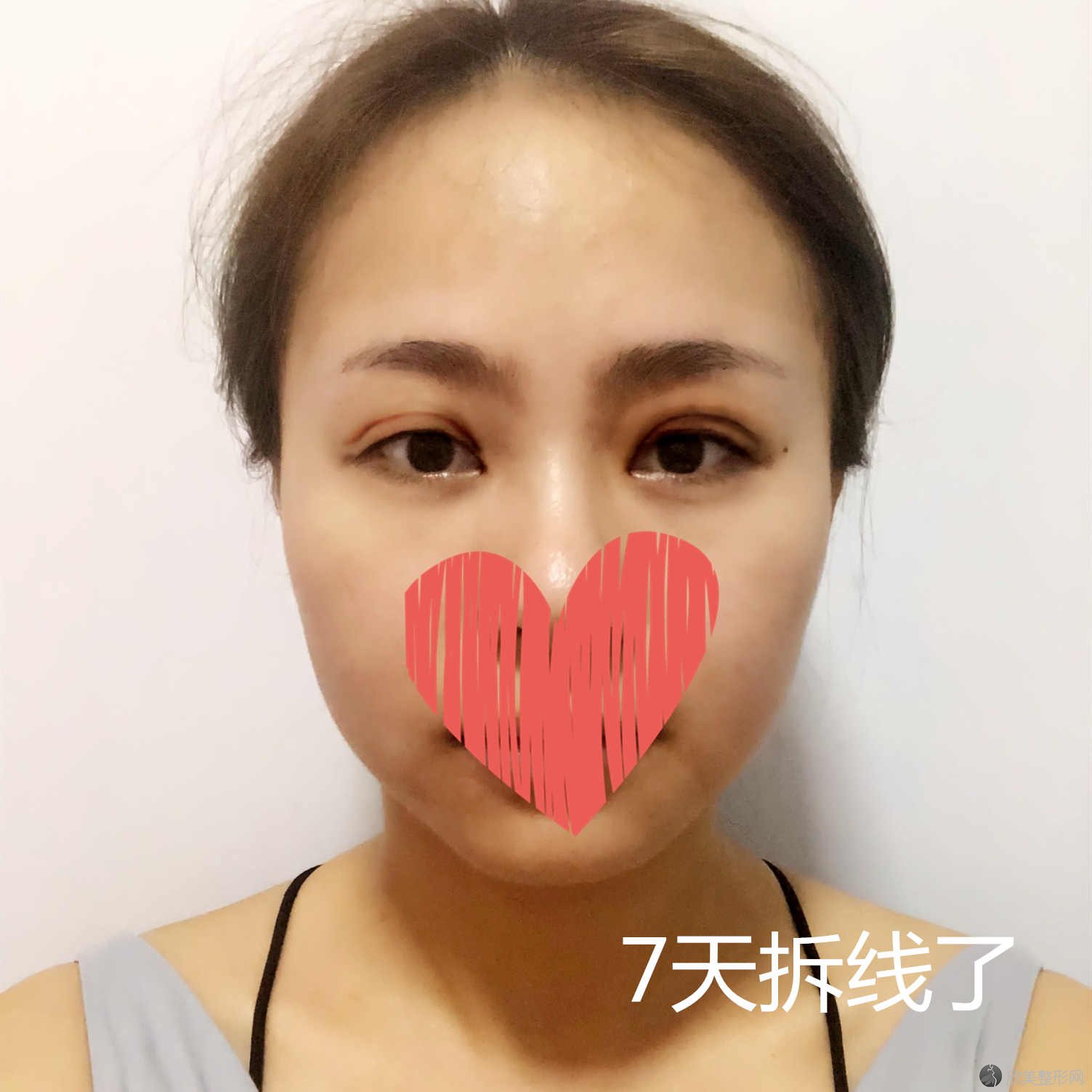 上海市东方医院刘庆阳做埋线双眼皮效果图术后1-7天分享