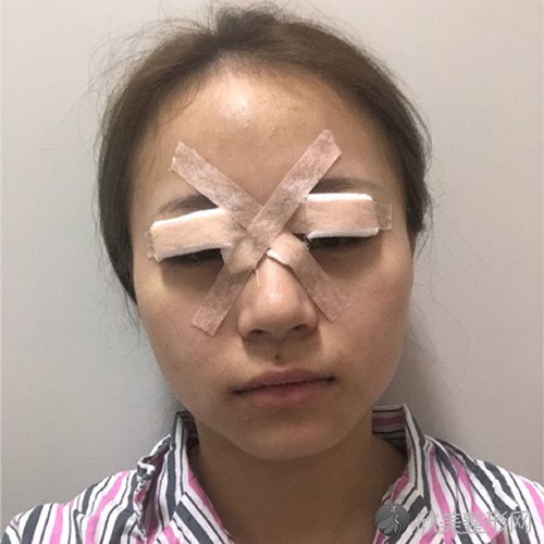 上海市东方医院刘庆阳做埋线双眼皮效果图术后1-7天分享