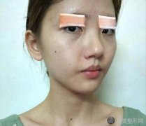 杭州星光丽格张金辉医生全切双眼皮术怎么样？案例效果来了