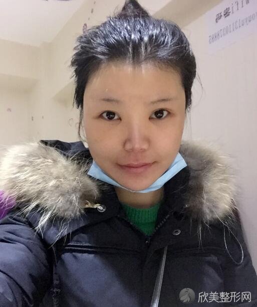 刘成胜下颌角手术案例分享
