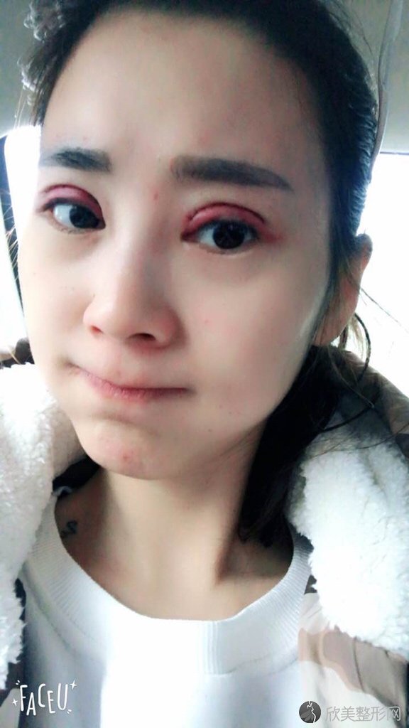 青岛陈振宇双眼皮手术案例,术后恢复效果分享