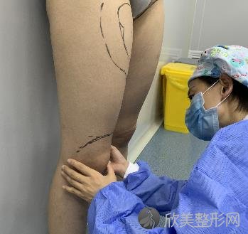 深圳艾博医院抽脂案例恢复过程分享,快来看看效果吧