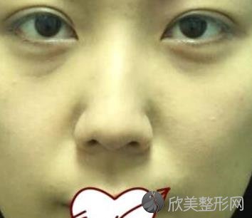 北京惠美整形医院的耳软骨鼻子案例术后恢复效果图分享
