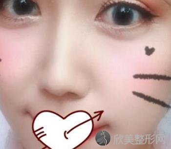 北京惠美整形医院的耳软骨鼻子案例术后恢复效果图分享