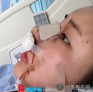 上海第九医院宋欣割双眼皮怎么样？两个月的案例效果展示