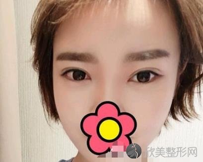湖南省人民医院整形科双眼皮案例,术后恢复效果分享