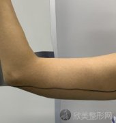 浙江医科大学第二医院整形外科全身吸脂案例术后恢复效果分享