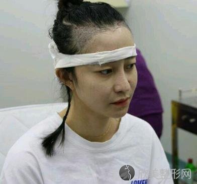 广东省人民医院整形外科植发案例效果分享，再也不秃头啦