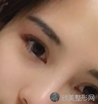 北京八大处周传德双眼皮真实案例,术后恢复效果分享