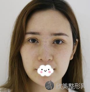 上海gk整形医院隆鼻手术案例,术后恢复过程分享