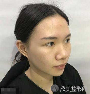 北京沃尔冯延平隆鼻手术案例分享，真心觉得小姐姐术后更漂亮了