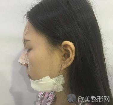 北京沃尔冯延平隆鼻手术案例分享，真心觉得小姐姐术后更漂亮了