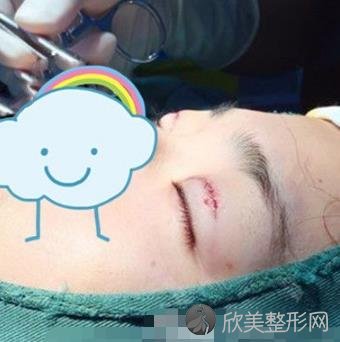 中山市第三医院朱雷韩国双眼皮案例,术后恢复效果分享
