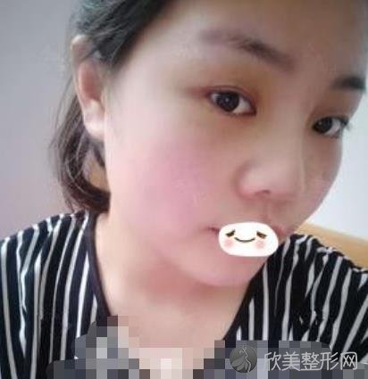 武汉亚太医院的鼻子整形案例分享，术后恢复效果展示