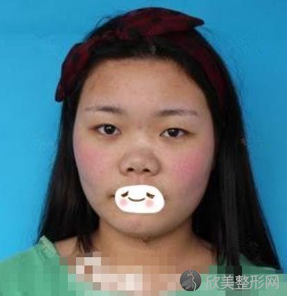 武汉亚太医院的鼻子整形案例分享，术后恢复效果展示
