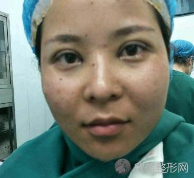 武汉韩亚整形医院的双眼皮效果如何？真实案例分享+前后对比效果图