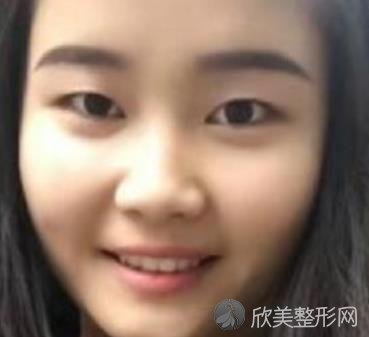 海城香农美容院双眼皮案例恢复过程分享