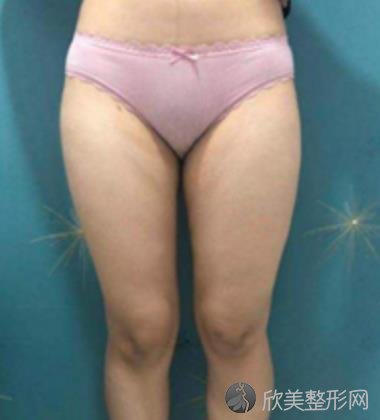 上海市第九医院吸脂技术如何？小姐姐真实案例分享,来看术后效果图！