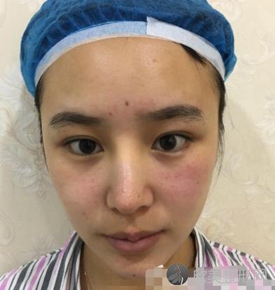 重庆西南医院整形科割双眼皮技术怎么样？案例恢复效果分享，眼睛又大又好看