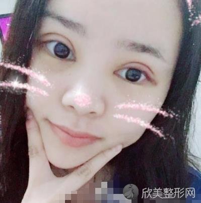 重庆西南医院整形科割双眼皮技术怎么样？案例恢复效果分享，眼睛又大又好看