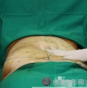 武汉同济医院整形外科吸脂瘦腰腹案例术后效果分享 术后三个月拥有小蛮腰