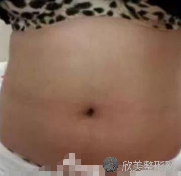 武汉同济医院整形外科吸脂瘦腰腹案例术后效果分享 术后三个月拥有小蛮腰