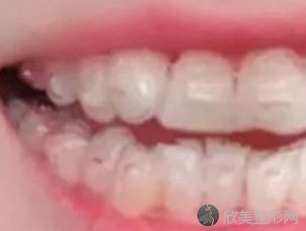 太仓中医医院矫正牙齿案例分享，来看效果对比图！