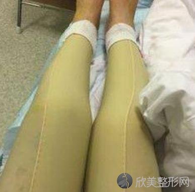 南京美贝尔吸脂瘦腿案例分享,术后效果太好了，终于摆脱大象腿了