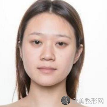 西京医院整形科隆鼻案例分享 ,效果对比图展示,术后颜值提升不少呢