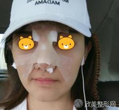 北京大学第三医院整形外科隆鼻案例恢复过程及效果对比图分享