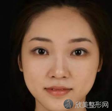 北京八大处隆鼻案例术后恢复过程图分享