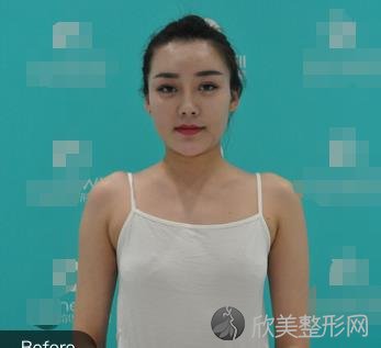 北京邦定陈医生内镜下动态假体隆胸案例分享,价目表一览