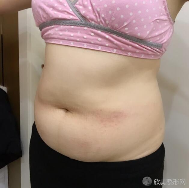 星群医疗整形医院流体动力腰部吸脂案例分享,产后减肥当辣妈！